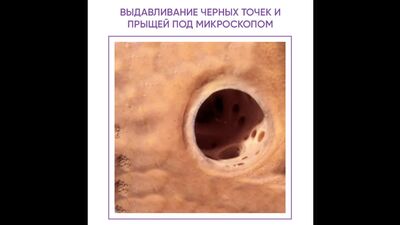 Выдавливание прыщей и черных точек под микроскопом